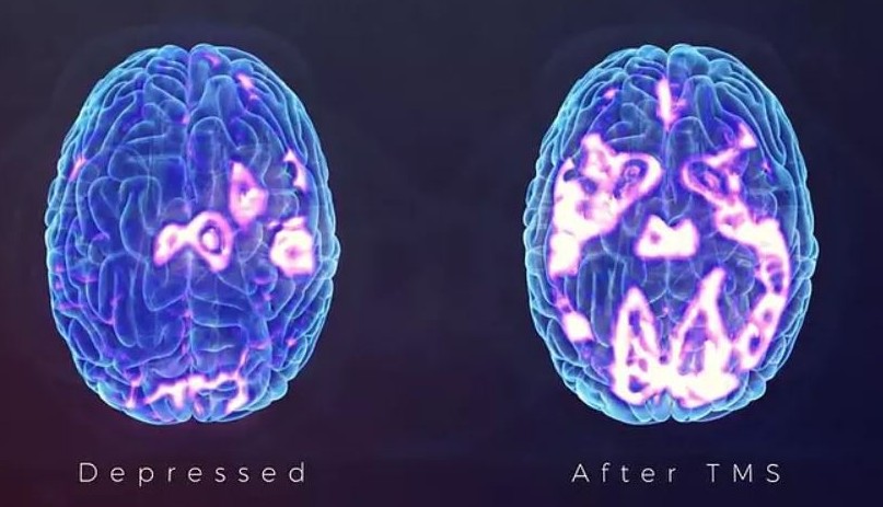 4-fMRI depressed-vs-tms-brain