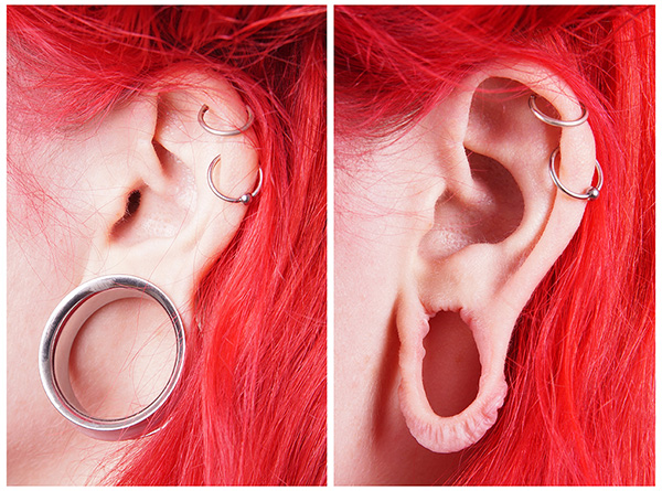 Earlobe Repair, Stretched or Torn Earlobe