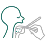 Tonsillectomy Procedure Illustration