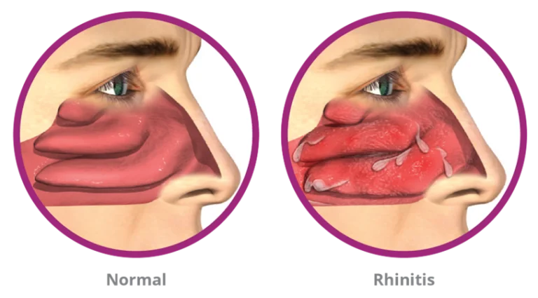 Rhinitis