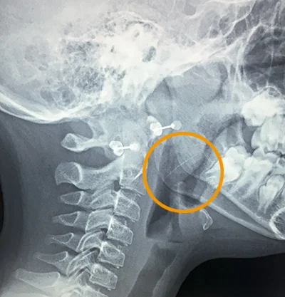 wire lateral xray