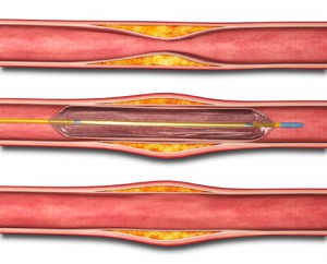 Catheterization Newark DE