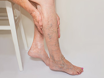 Do Varicose Veins Go Away? - Delaware Vein Center