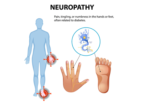 Neuropathy