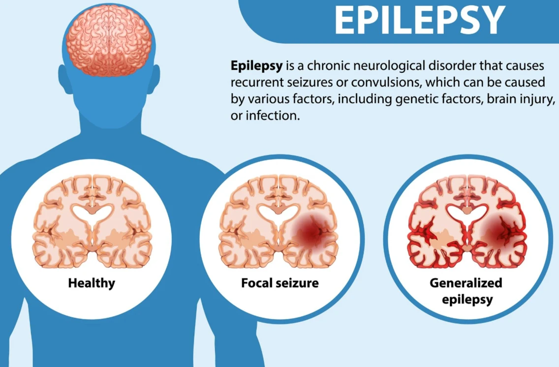 Epilepsy Guide
