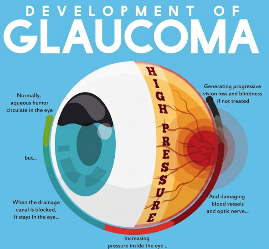 glaucoma