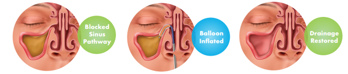 Benefits Of Balloon Sinuplasty Goshen NY