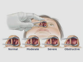 Causes Of Sinusitis NY Center For Sinus Relief Causes Of Sinusitis NY Center For Sinus Relief