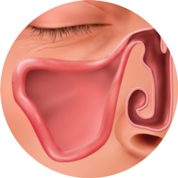 inflamed nasal turbinates